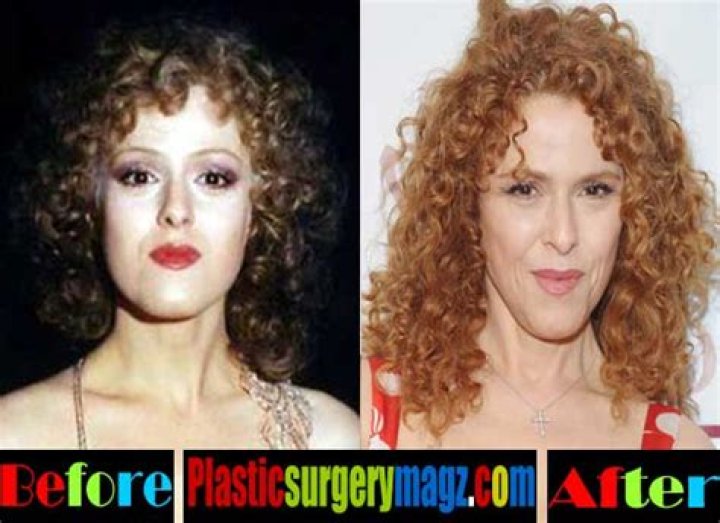 Bernadette Peters Plastic Surgery Before and After Botox Injections