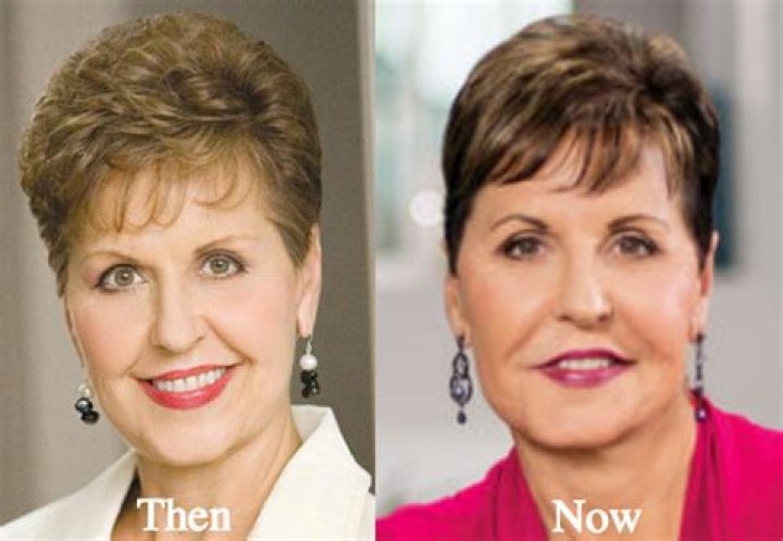 Joyce Meyer Lip Augmentation Plastic Surgery Before and After