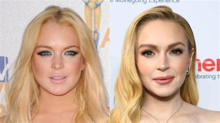Lindsay Lohan Plastic Surgery: From Rhinoplasty to Fillers and Everything We Know So Far!